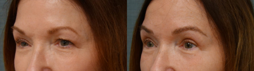 Bilateral Upper Eyelid Blepharoplasty, Left Mini Brow Lift, Right Upper Eyelid Internal Ptosis Repair, Chemical Peel to Bilateral Lower Eyelids Patient 23-C Bilateral Upper Eyelid Blepharoplasty, Left Mini Brow Lift, Right Upper Eyelid Internal Ptosis Repair, Chemical Peel to Bilateral Lower Eyelids Patient 23-C