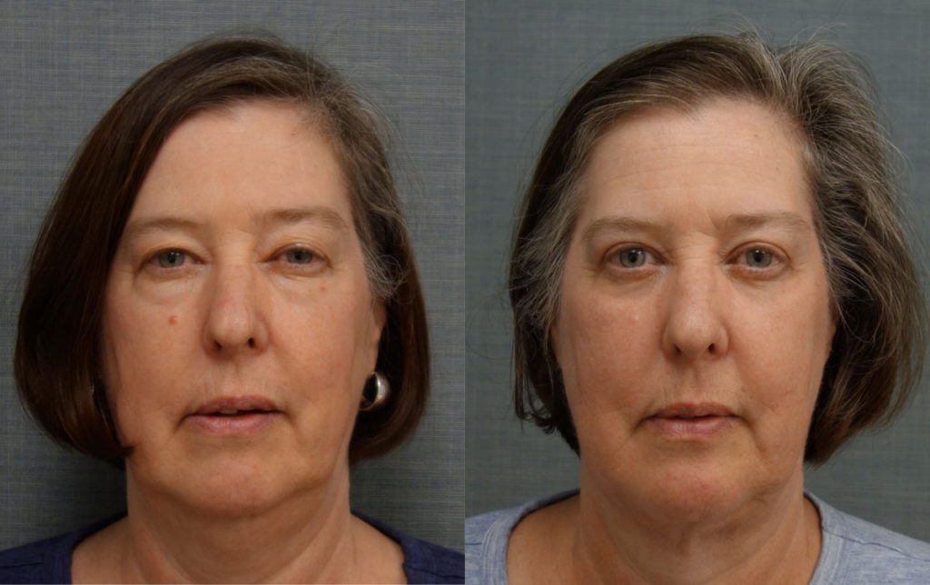 Bilateral Upper and Lower Eyelid Blepharoplasty, Eyelid Laser Resurfacing and FaceTite with Micro-Liposuction, Morpheus Microneedling Lower Face and Neck Patient 24-A 