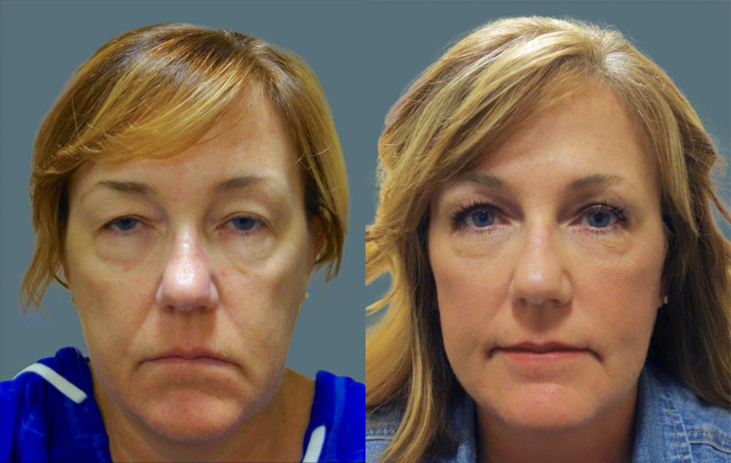 Bilateral Upper Eyelid Blepharoplasty, Ptosis Repair Patient 17 