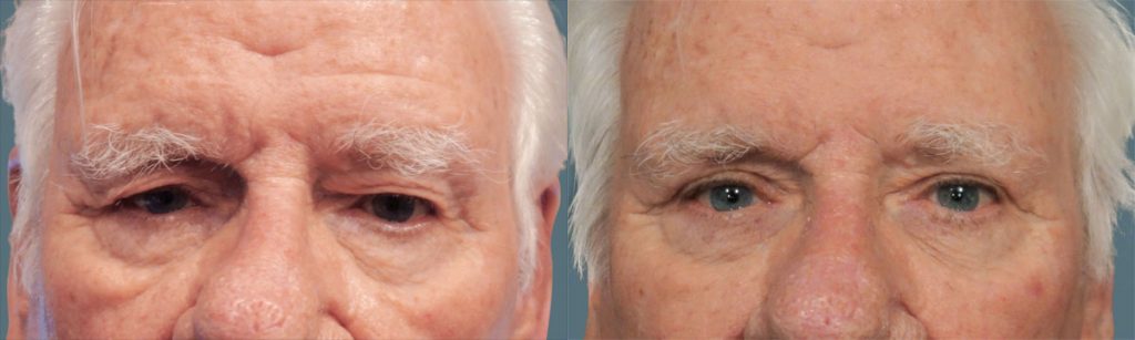 Upper Eyelid Blepharoplasty Patient 42-C 