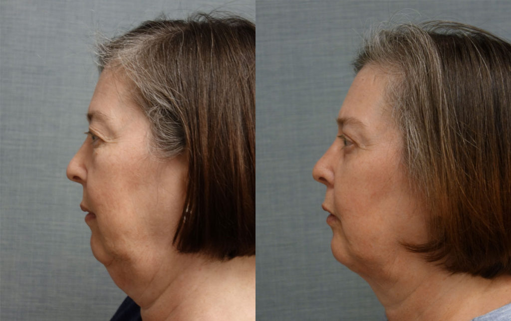 Bilateral Upper and Lower Eyelid Blepharoplasty, Eyelid Laser Resurfacing and FaceTite with Micro-Liposuction, Morpheus Microneedling Lower Face and Neck Patient 24-C 