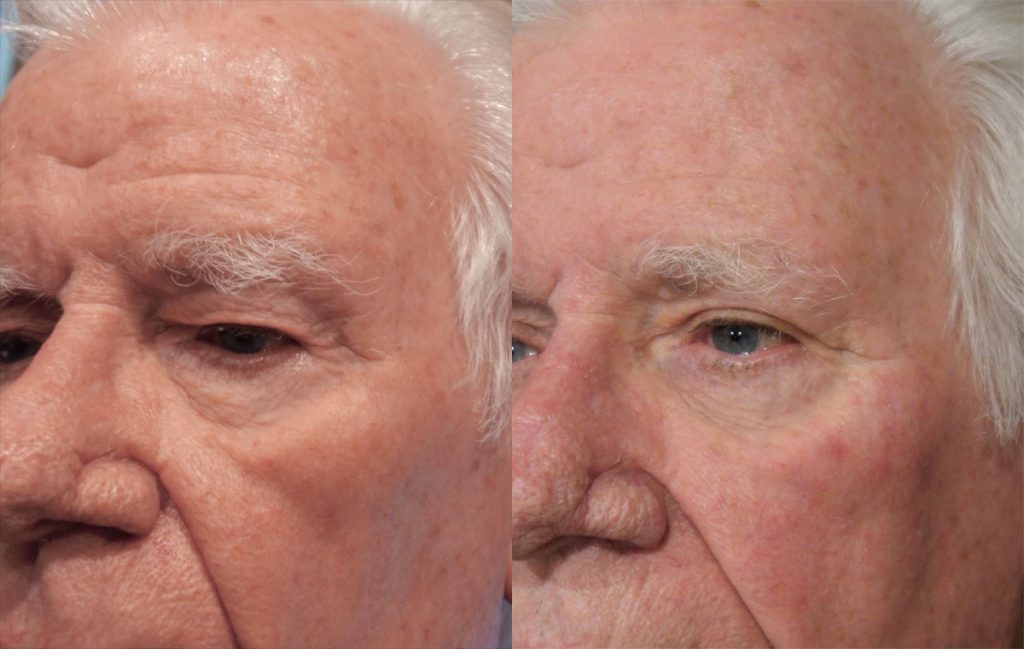 Upper Eyelid Blepharoplasty Patient 42-B 