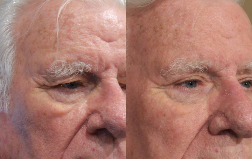 Upper Eyelid Blepharoplasty Patient 42-A 