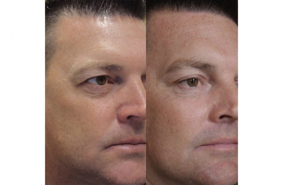 Upper Eyelid Blepharoplasty Patient 21 