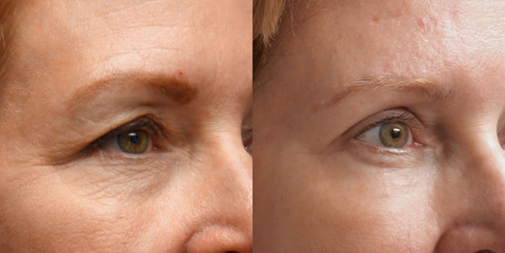 Upper and Lower Eyelid Blepharoplasty, Mini Temporal Brow Lift and Eyelid Laser Resurfacing Patient 06 
