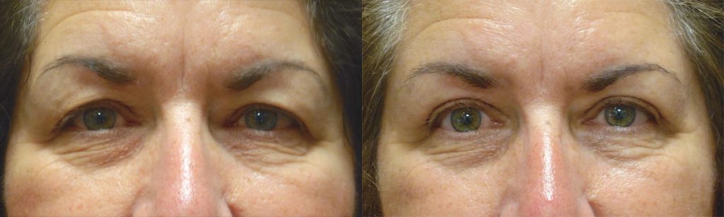 Upper Eyelid Blepharoplasty Patient 25-A 