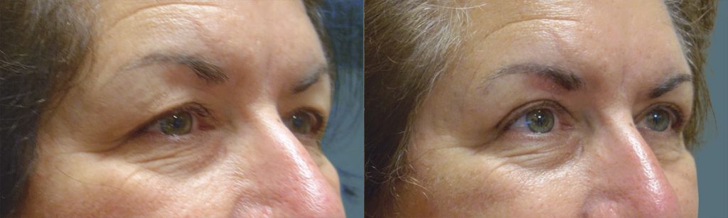 Upper Eyelid Blepharoplasty Patient 26-B 