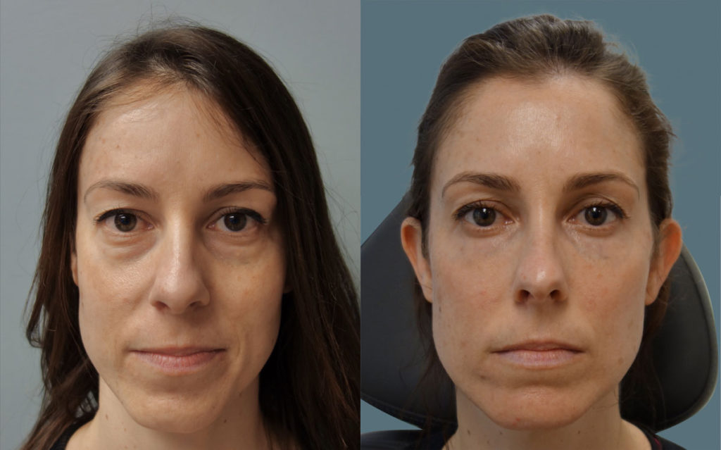 Bilateral Lower Eyelid and Midface Filler - 3 Years After Photo Patient 01-A 