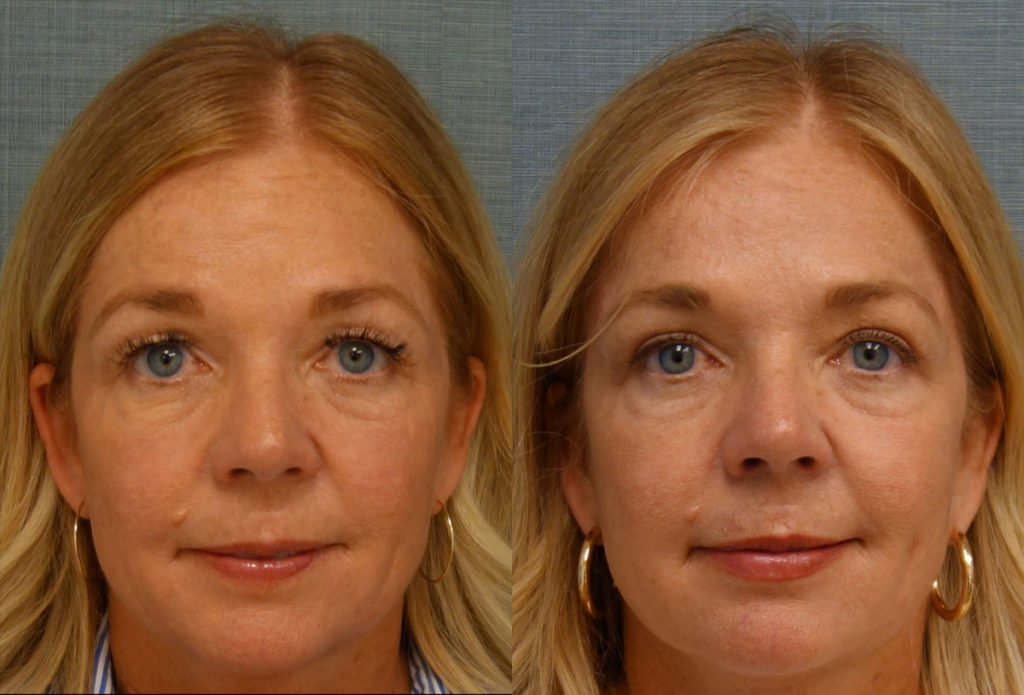 Upper Eyelid Blepharoplasty, Mini Brow Lift Patient 22-A 