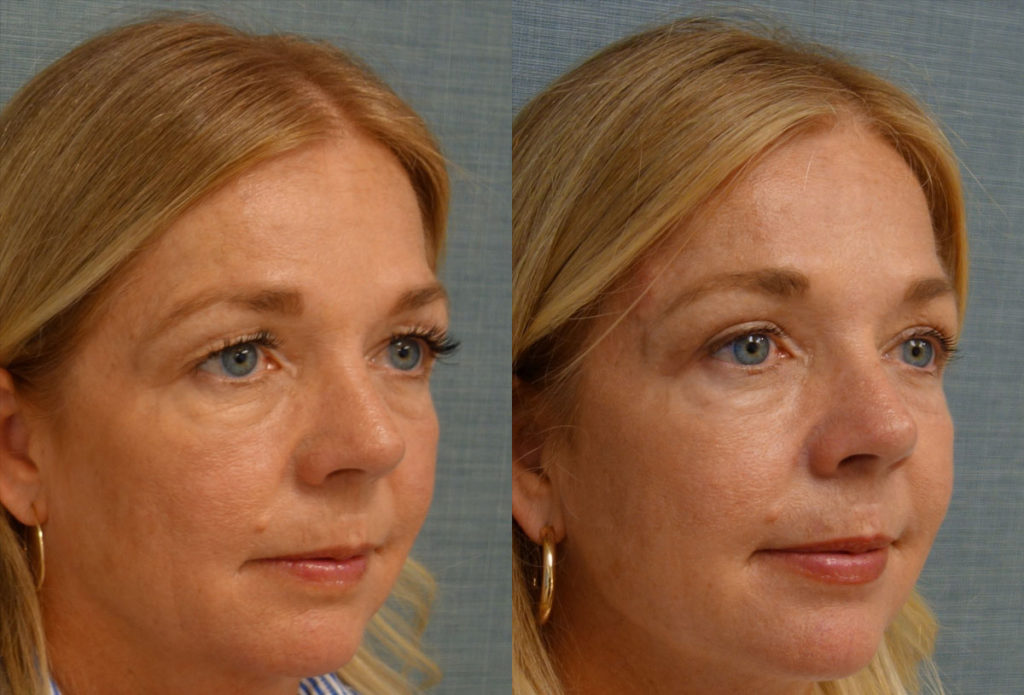 Upper Eyelid Blepharoplasty, Mini Brow Lift Patient 22-B 