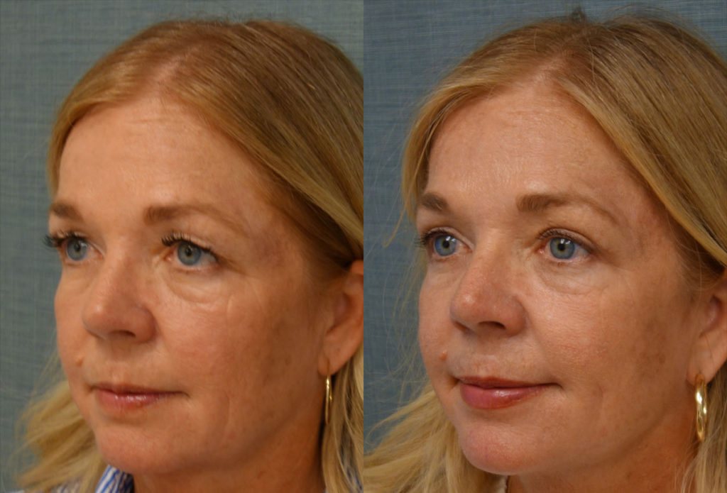 Upper Eyelid Blepharoplasty, Mini Brow Lift Patient 22-C 