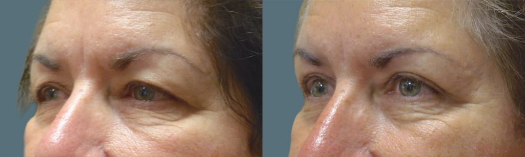 Upper Eyelid Blepharoplasty Patient 26-C 