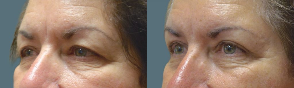 Upper Eyelid Blepharoplasty Patient 25-C 