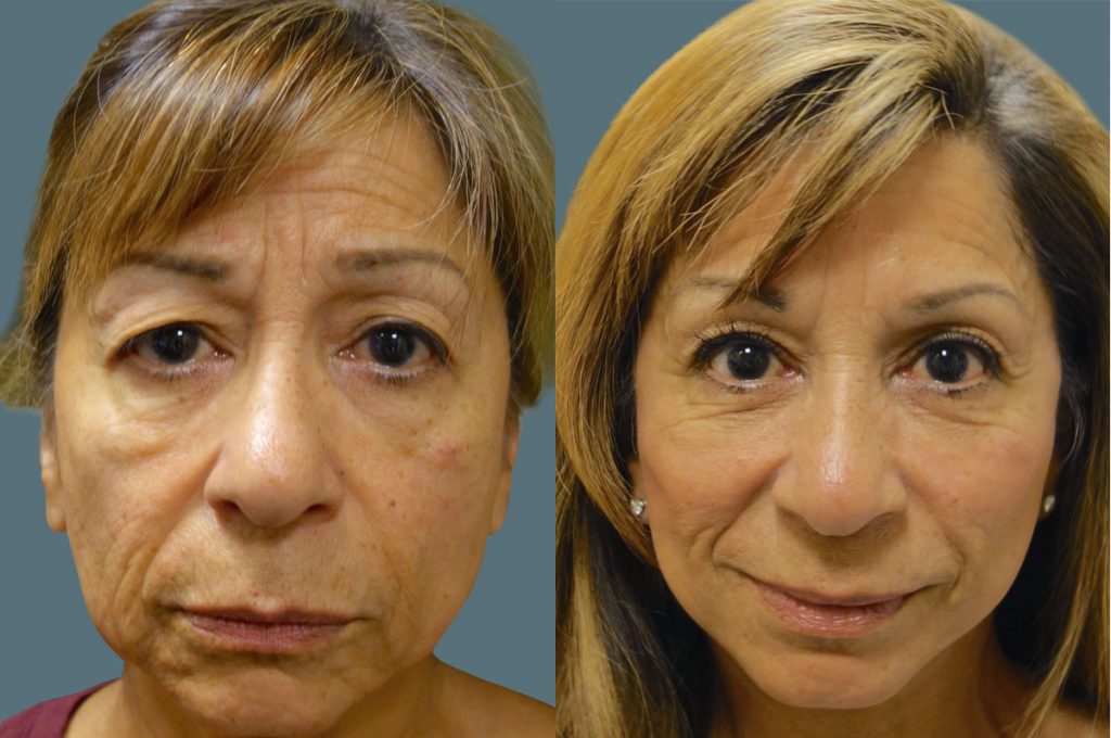 Upper Eyelid Blephoraplasty Patient 41 