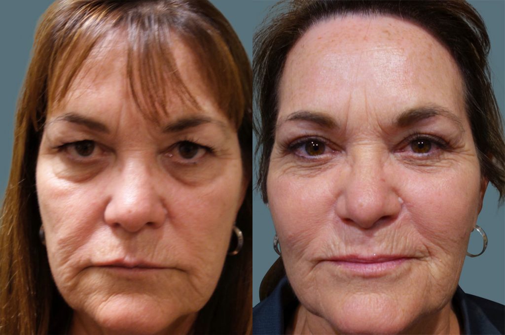 Upper Eyelid Blepharoplasty Patient 41-C 