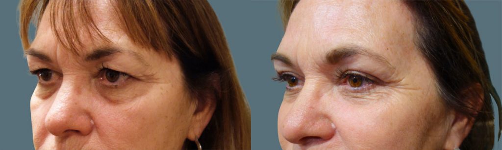 Upper Eyelid Blepharoplasty Patient 42-B 