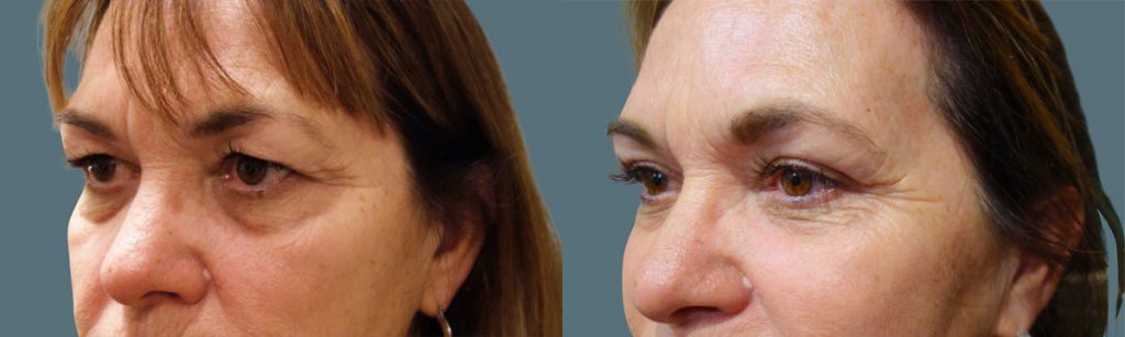 Upper Eyelid Blepharoplasty Patient 41-B 