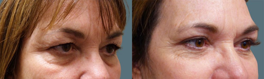 Upper Eyelid Blepharoplasty Patient 41-A 