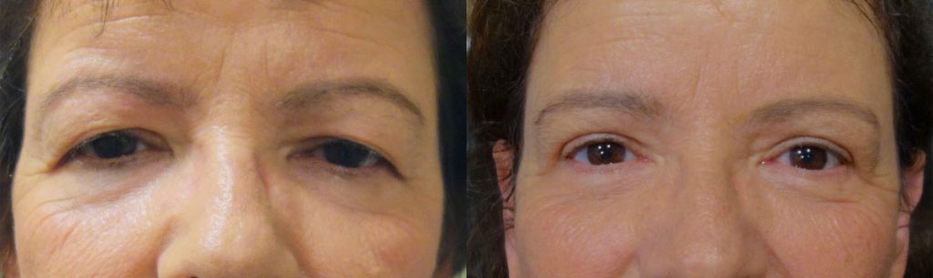 Upper Eyelid Blepharoplasty and Lateral Brow Lift Patient 43-C 