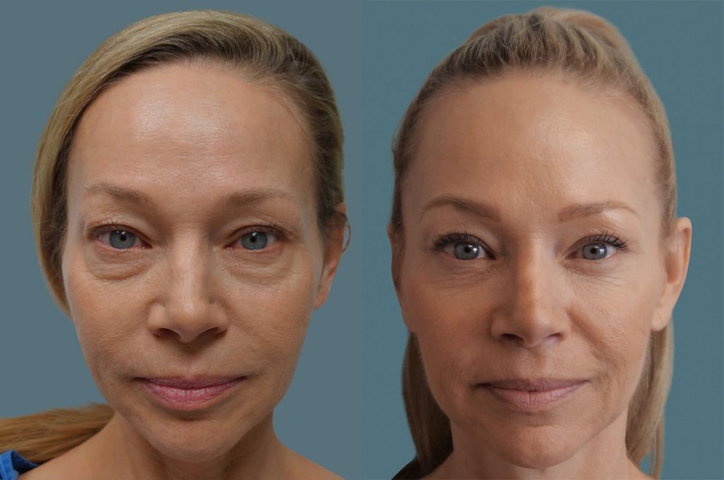Upper and Lower Eyelid Blepharoplasty with Eyelid Laser Resurfacing Patient 17-A 