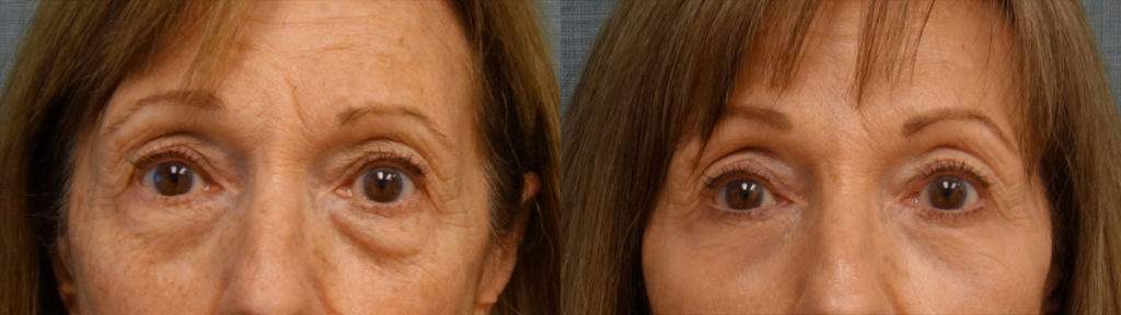 Lower Eyelid Blepharoplasty with Internal Cheek Elevation and Chemical Peel Patient 34 