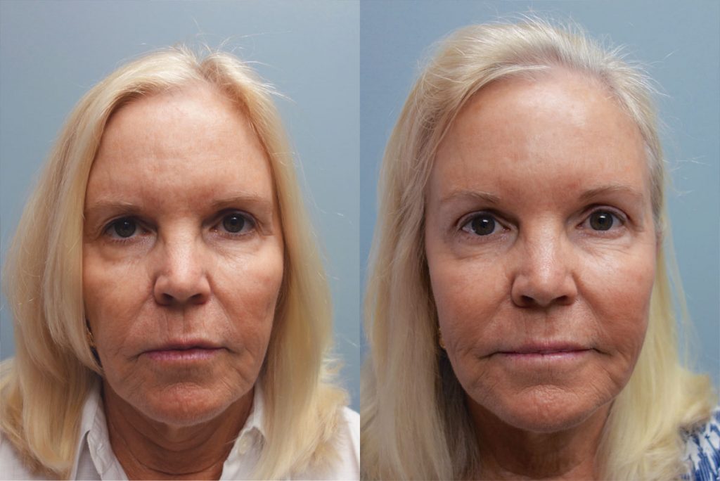 Bilateral Upper Lid Blepharoplasty and Mini Brow Lift Patient 16-A 
