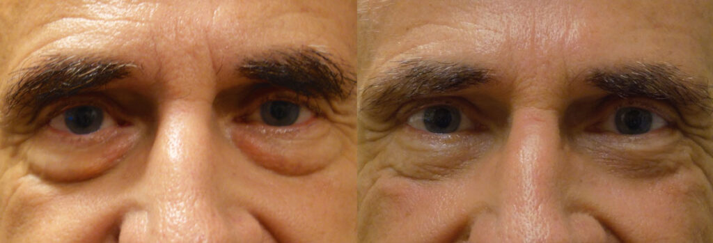 Lower Eyelid Blepharoplasty with Fat Transposition Patient 24-A 