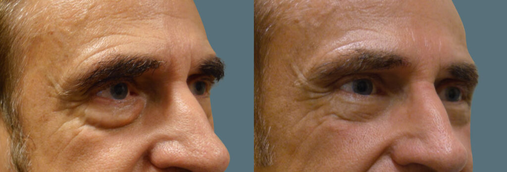 Lower Eyelid Blepharoplasty with Fat Transposition Patient 24-B 