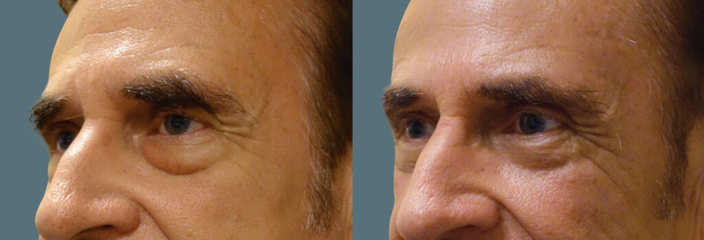 Lower Eyelid Blepharoplasty with Fat Transposition Patient 24-C 