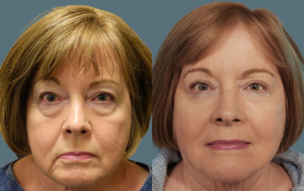 Upper and Lower Eyelid Blepharoplasty with Internal Cheek Elevation Patient 21-A 