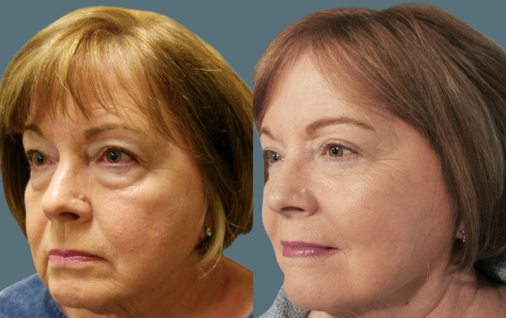 Upper and Lower Eyelid Blepharoplasty with Internal Cheek Elevation Patient 21-B 