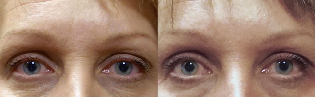 Botox for between Eyebrows (glabella) Patient 13-A 