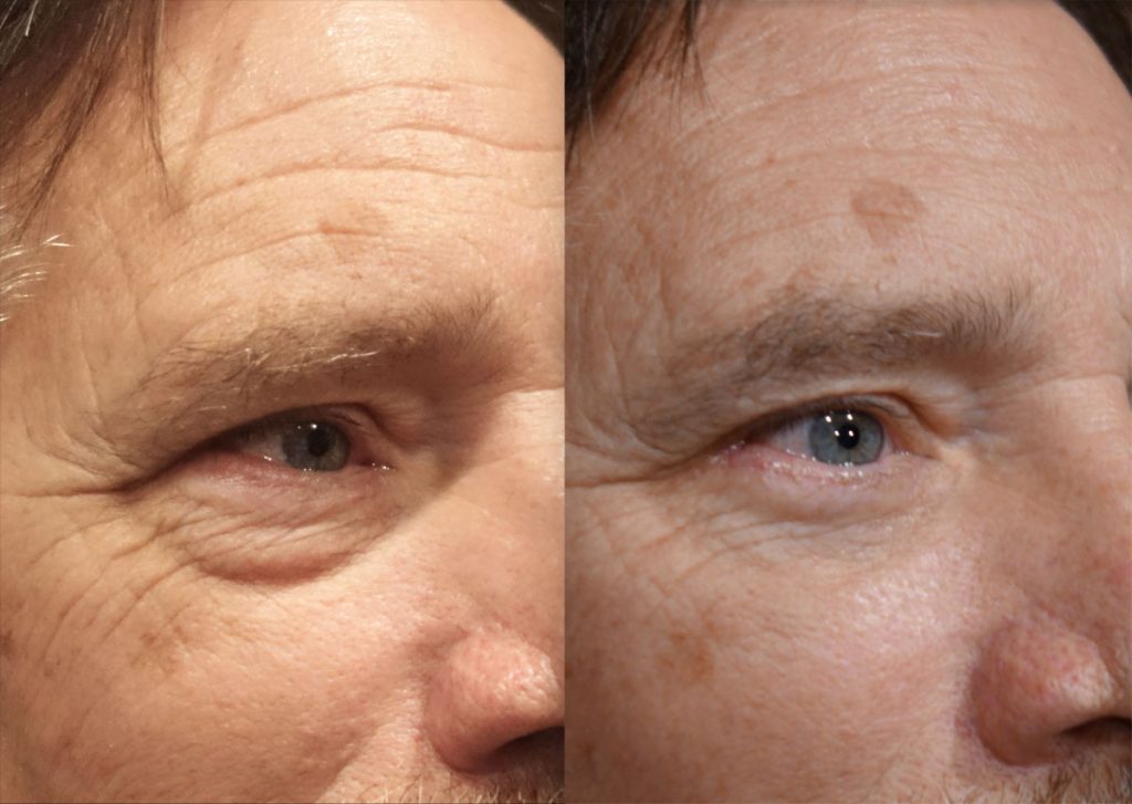 Lower Eyelid Blepharoplasty with Internal Cheek Elevation Patient 14-A 