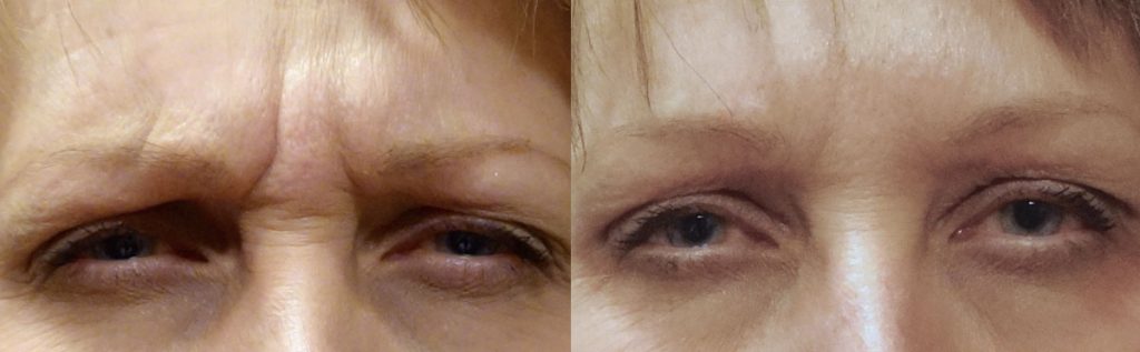 Botox for between Eyebrows (glabella) Patient 13-B 