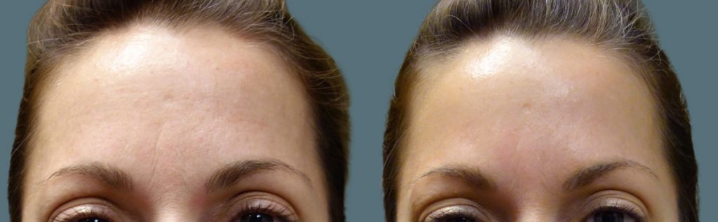 Botox for Forehead lines Patient 10-A 