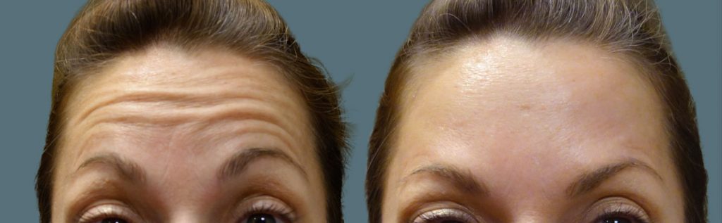 Botox for Forehead lines Patient 10-B 