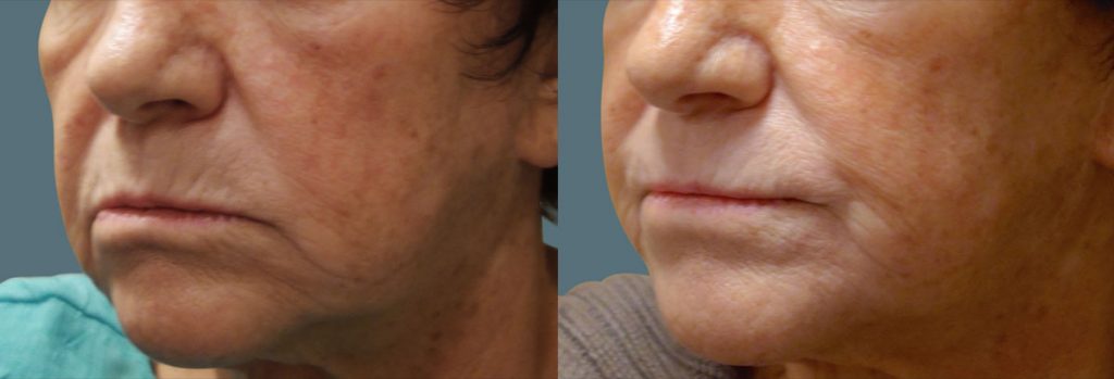 Juvederm and Belotero to the Lips and Around the Mouth Patient 11-B 