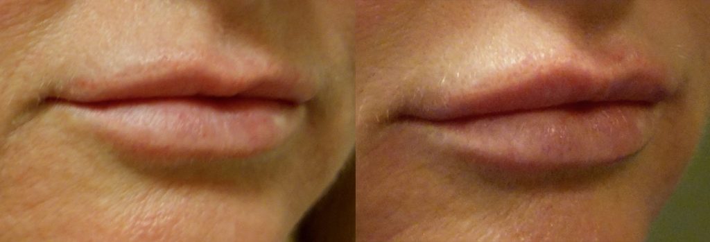 Lip Filler Patient 15-A 