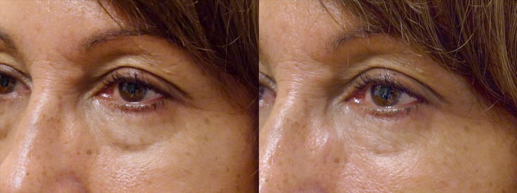 Bilateral Lower Eyelid Filler Patient 10 