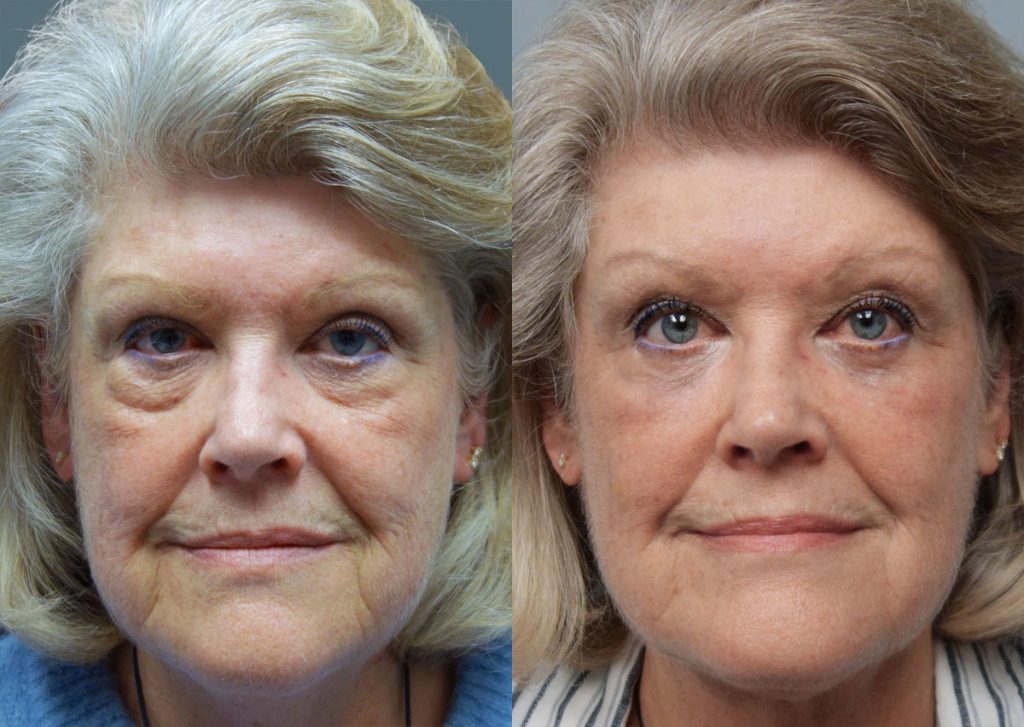 Lower Eyelid Blepharoplasty with Internal cheek Elevation Patient 23-A 