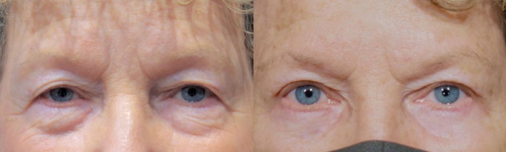 Upper Eyelid Blepharoplasty Patient 46 