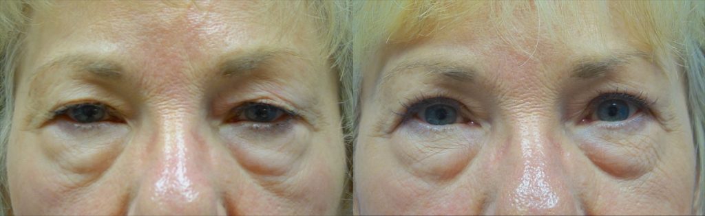 Bilateral Upper Eyelid Blepharoplasty, Bilateral Internal Ptosis Repair NO BROW Patient 09-A 