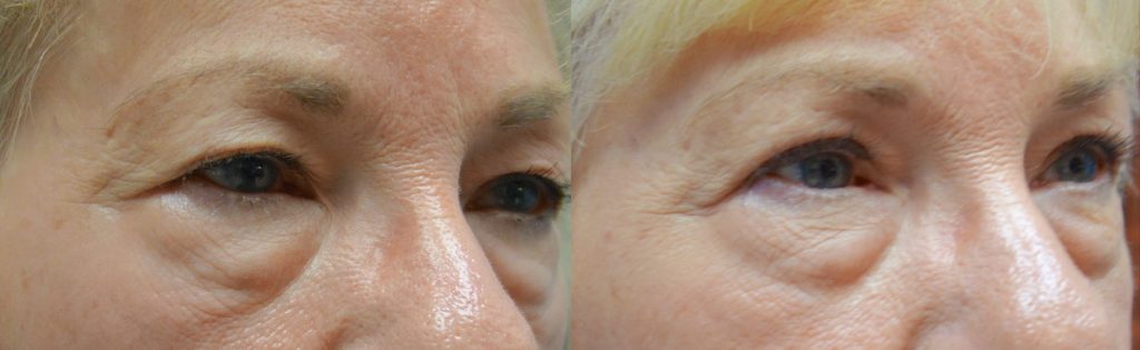 Bilateral Upper Eyelid Blepharoplasty, Bilateral Internal Ptosis Repair NO BROW Patient 09-B 