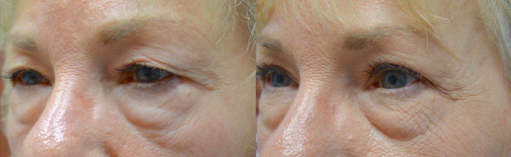 Bilateral Upper Eyelid Blepharoplasty, Bilateral Internal Ptosis Repair NO BROW Patient 09-C 