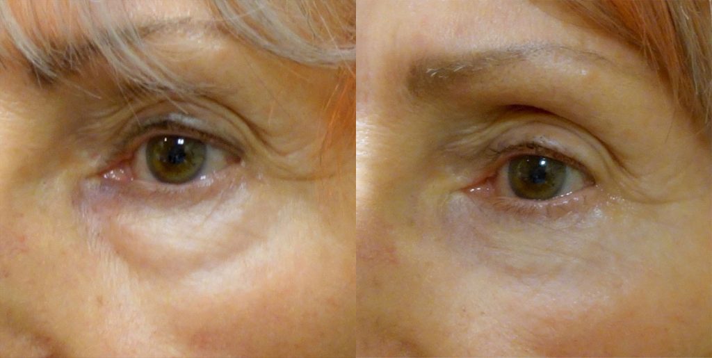 Lower Eyelid Blepharoplasty with Fat Transposition Patient 33 