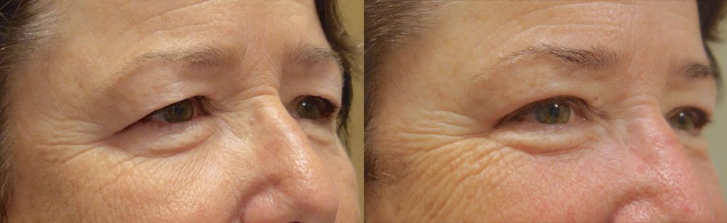 Bilateral Upper Eyelid Blepharoplasty (No Brow) Patient 02-B 