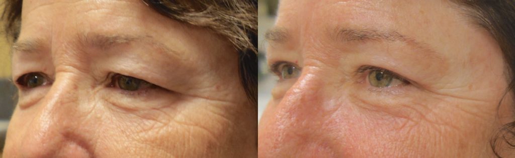 Bilateral Upper Eyelid Blepharoplasty (No Brow) Patient 02-C 