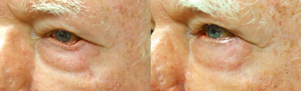 Left Lower Eyelid Ectropion Due to Prior Skin Cancer Excision- Repair with Scar Revision Patient 03 
