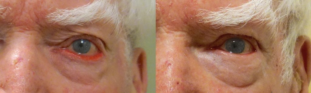Left Lower Eyelid Ectropion Repair with Skin Graft Patient 01-A 