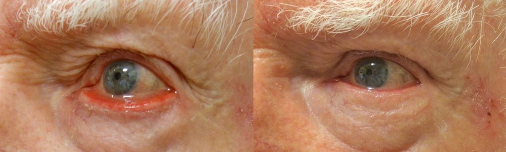 Left Lower Eyelid Ectropion Repair with Skin Graft Patient 01-B 